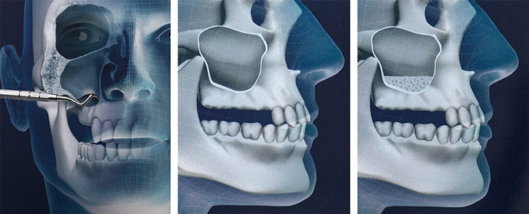 Синус -лифтинг