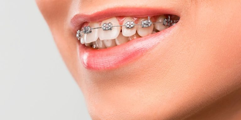 Брекеты на зубы
