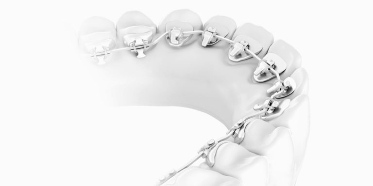 Лингвальные брекеты