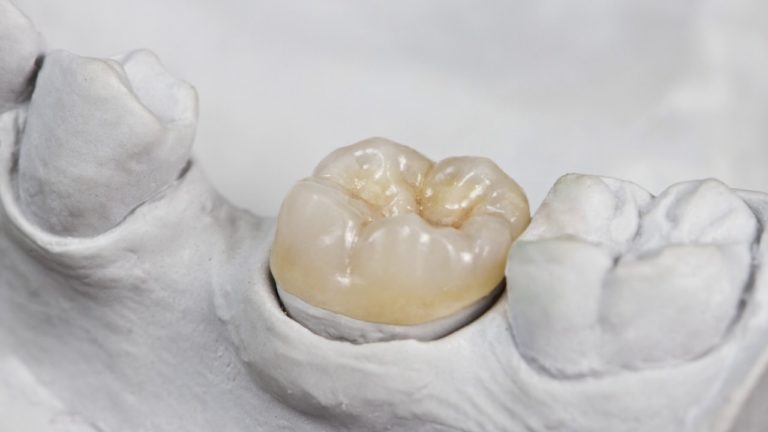 Зубные вкладки