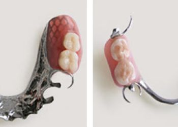 Бюгельный протез на кламмерах