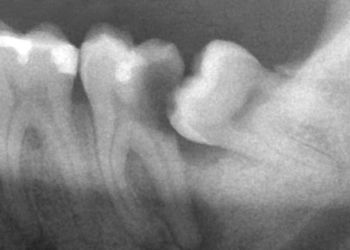 Прорезывание зуба мудрости у взрослых – затрудненное и нормально. Как снять боль при прорезывании зуба мудрости. Сколько растет зуб мудрости после прорезывания.
